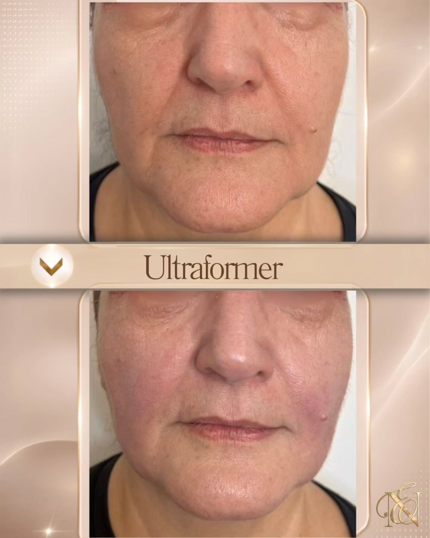 Ultraformer antes e depois